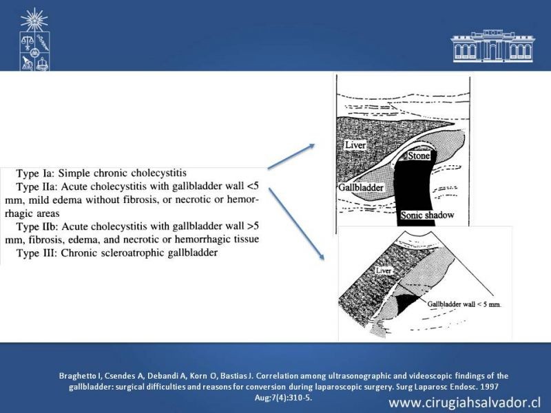 Diapositiva 37 de Vesícula Escleroatrófica