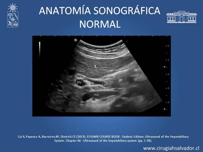 Diapositiva 8 de Vesícula Escleroatrófica