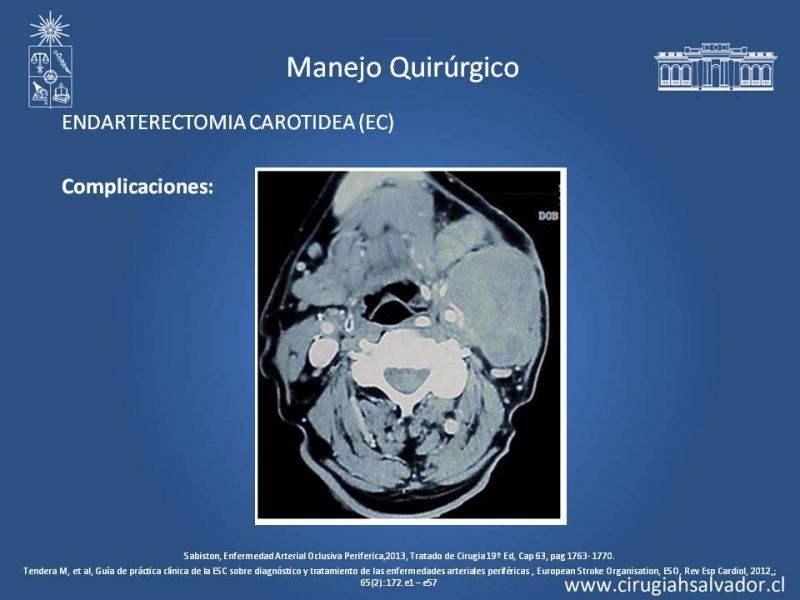 Diapositiva 26 de Estenosis Carotidea: Estudio y manejo quirúrgico