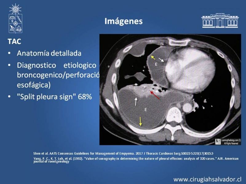 Diapositiva 8 de Empiema