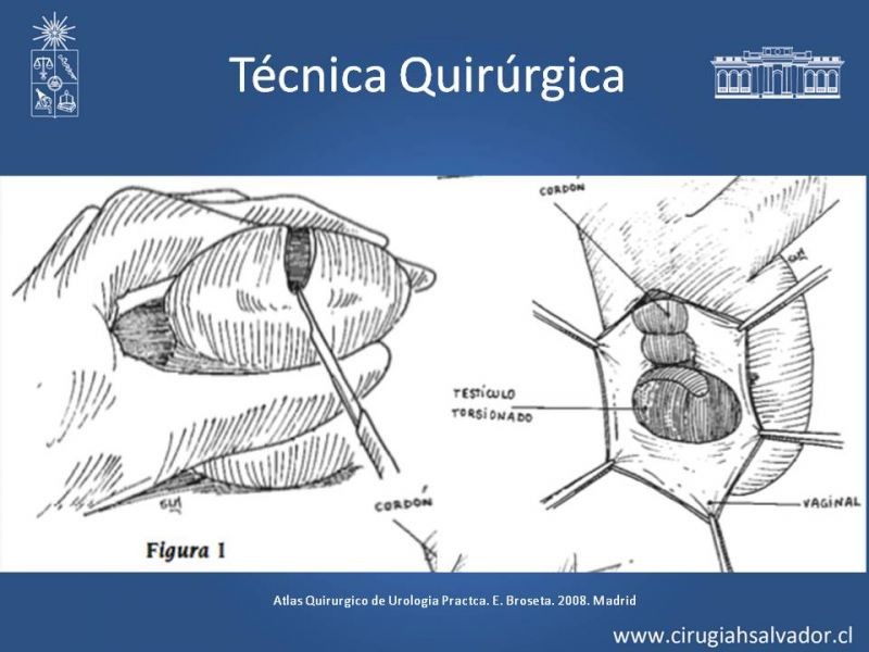 Diapositiva 15 de Manejo de Escroto Agudo