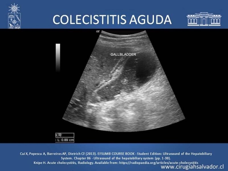 Diapositiva 15 de Vesícula Escleroatrófica