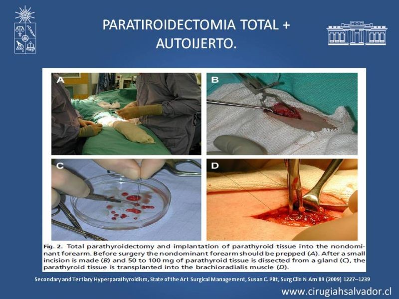 Diapositiva 24 de Hiperparatiroidismo 2º: Estudio, manejo e indicaciones quirúrgicas.
