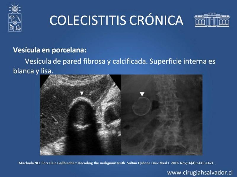 Diapositiva 24 de Vesícula Escleroatrófica