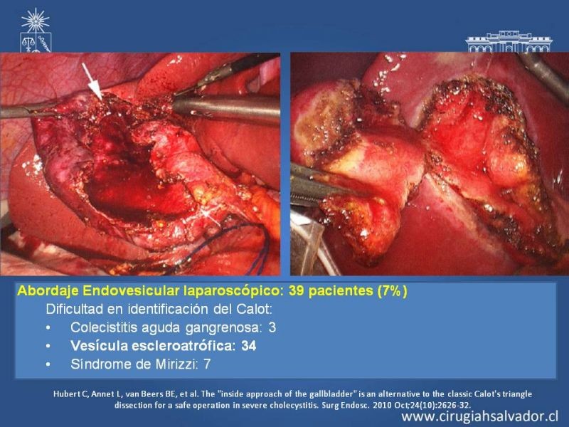 Diapositiva 60 de Vesícula Escleroatrófica