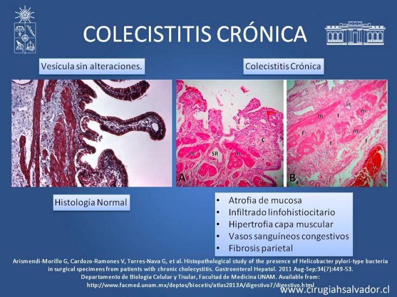 Diapositiva 20 de Vesícula Escleroatrófica