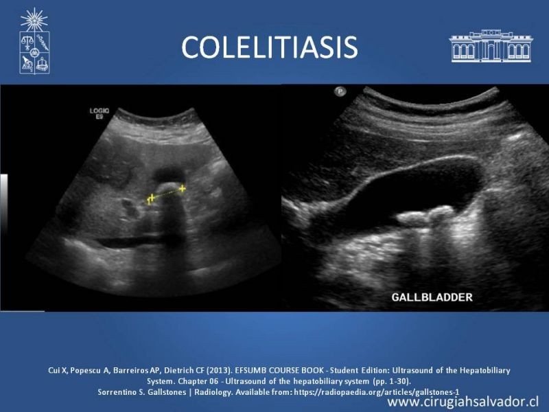 Diapositiva 13 de Vesícula Escleroatrófica