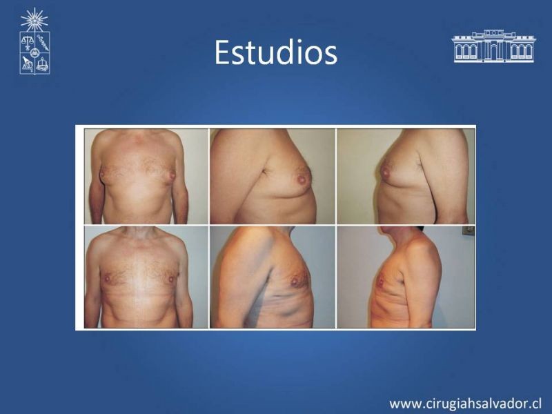 Diapositiva 19 de Ginecomastia