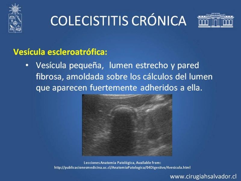 Diapositiva 22 de Vesícula Escleroatrófica