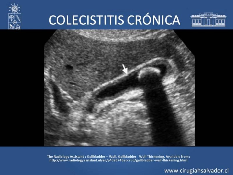 Diapositiva 16 de Vesícula Escleroatrófica