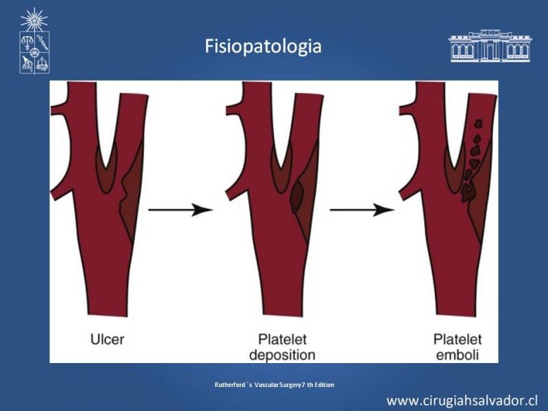 Diapositiva 6 de Estenosis Carotidea: Estudio y manejo quirúrgico