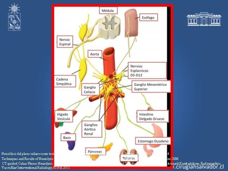 Diapositiva 5 de Alcoholización Plexo Solar