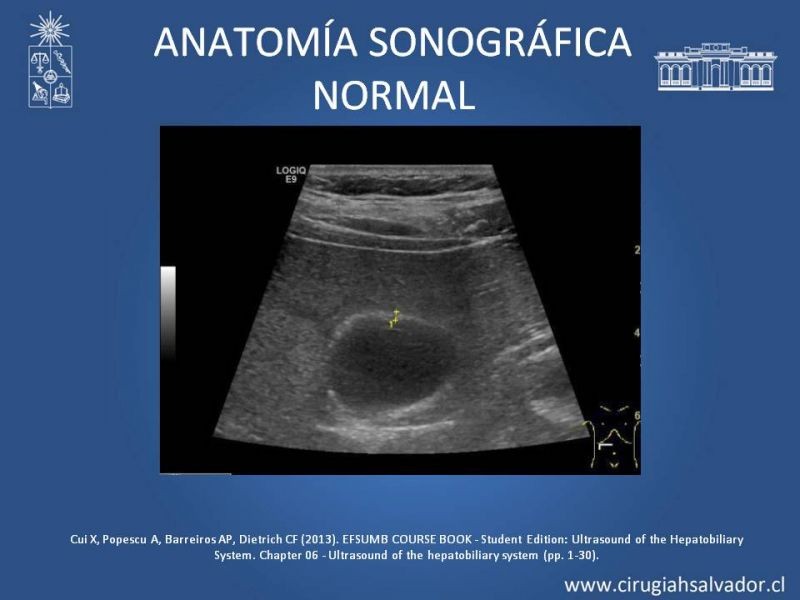 Diapositiva 7 de Vesícula Escleroatrófica