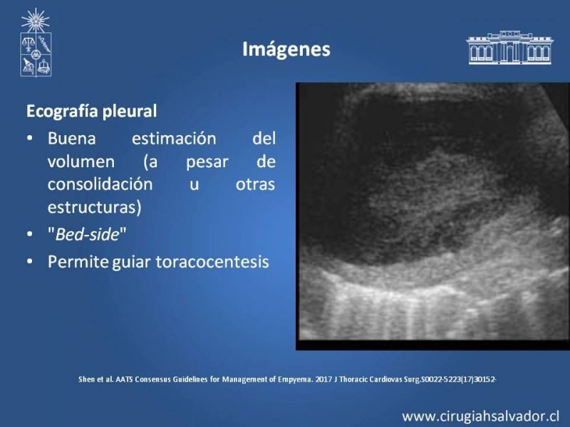 Diapositiva 7 de Empiema