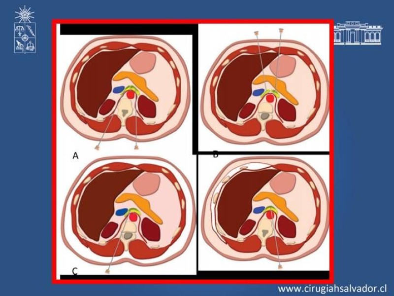 Diapositiva 11 de Alcoholización Plexo Solar
