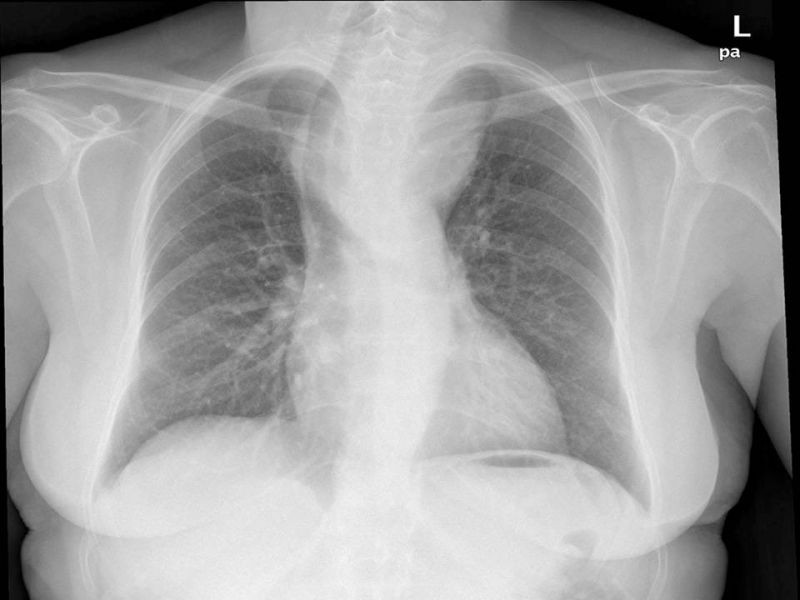 Diapositiva 8 de Bocio intratorácico