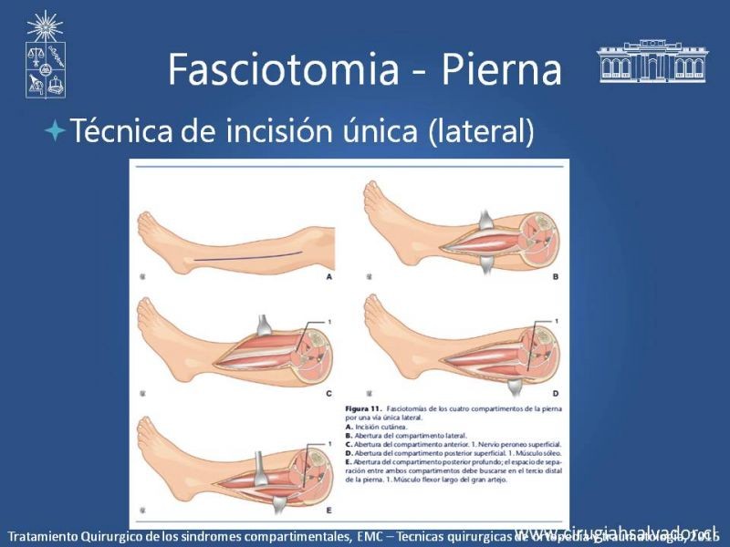 Diapositiva 21 de Síndrome Compartimental de Extremidades