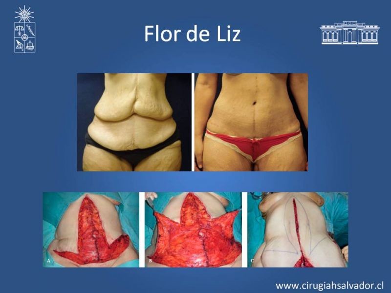 Diapositiva 21 de Lipectomía Abdominal