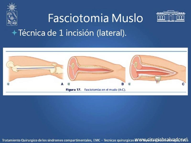 Diapositiva 24 de Síndrome Compartimental de Extremidades