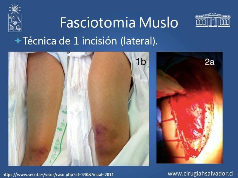 Diapositiva 25 de Síndrome Compartimental de Extremidades