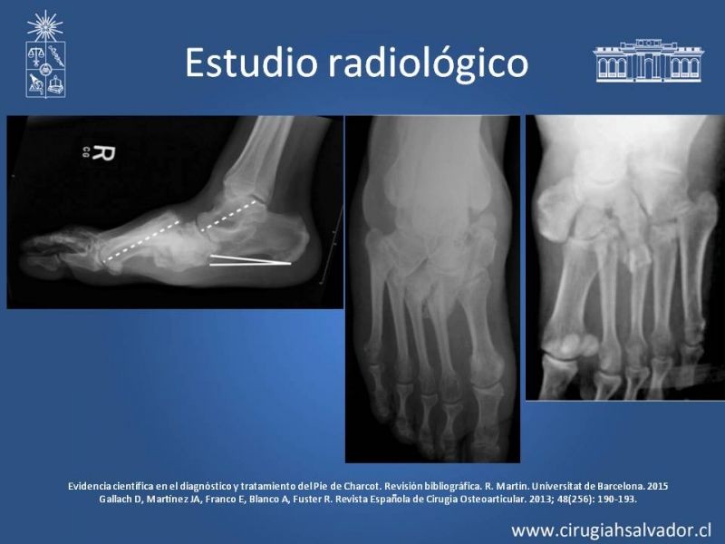 Diapositiva 13 de Artropatía de Charcot