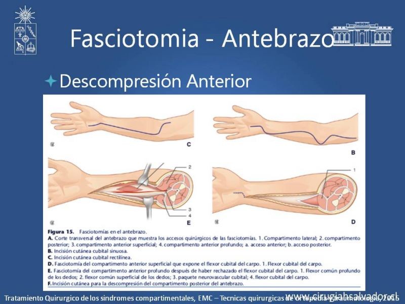 Diapositiva 28 de Síndrome Compartimental de Extremidades
