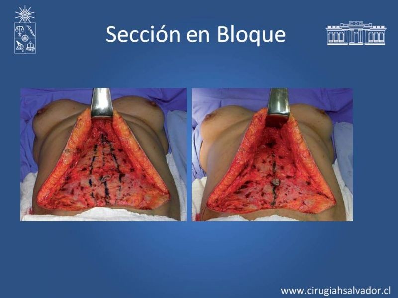 Diapositiva 19 de Lipectomía Abdominal