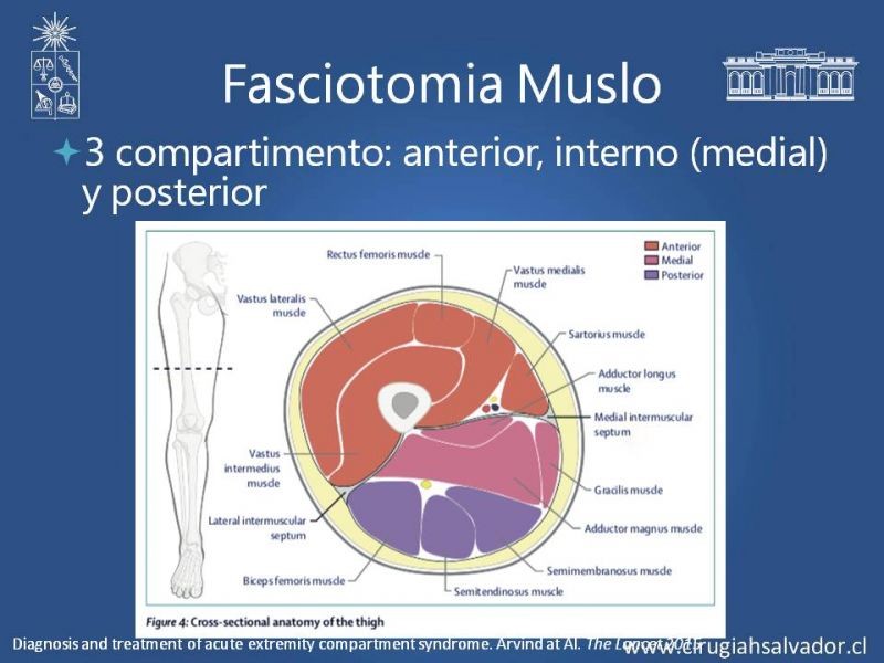 Diapositiva 23 de Síndrome Compartimental de Extremidades
