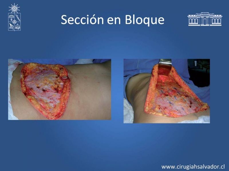 Diapositiva 18 de Lipectomía Abdominal