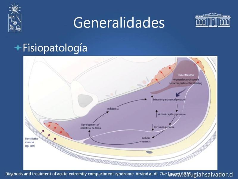 Diapositiva 6 de Síndrome Compartimental de Extremidades