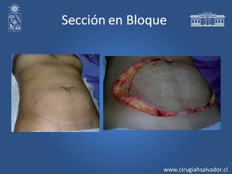 Diapositiva 17 de Lipectomía Abdominal