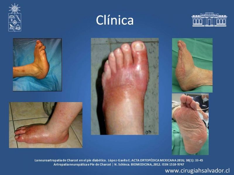 Diapositiva 10 de Artropatía de Charcot