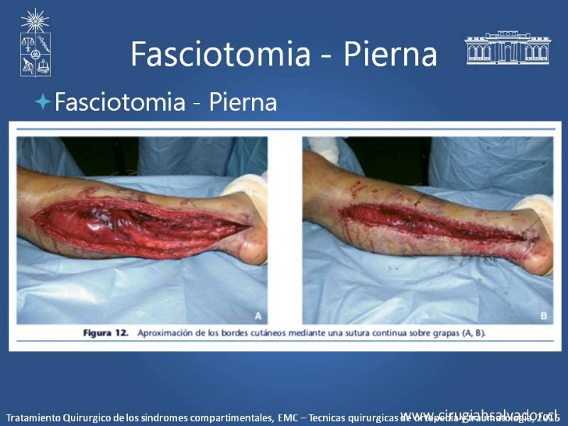 Diapositiva 22 de Síndrome Compartimental de Extremidades