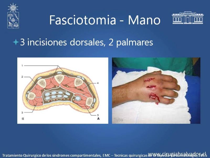 Diapositiva 32 de Síndrome Compartimental de Extremidades