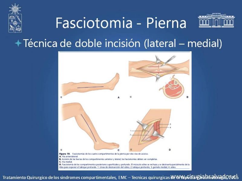Diapositiva 20 de Síndrome Compartimental de Extremidades