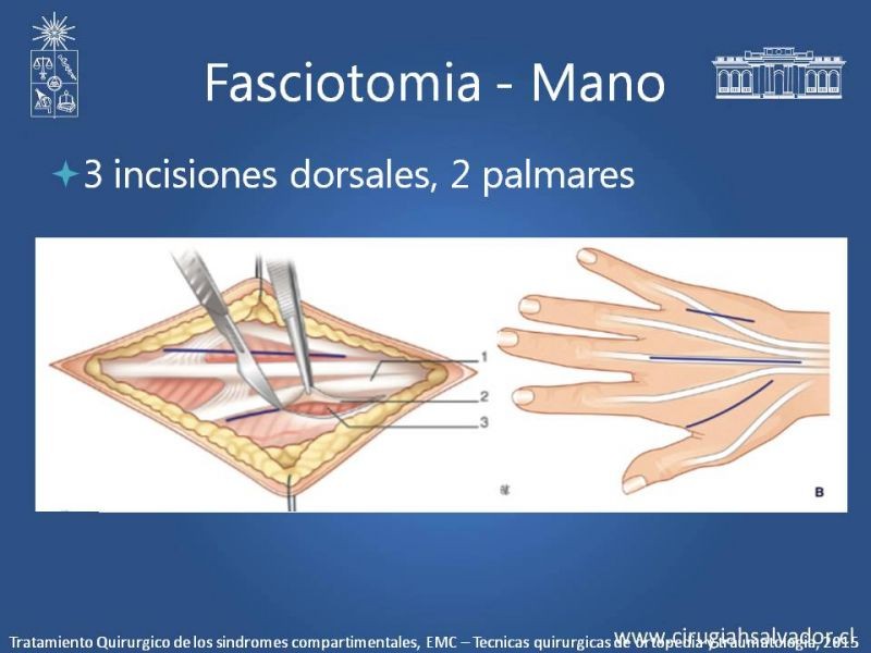 Diapositiva 33 de Síndrome Compartimental de Extremidades