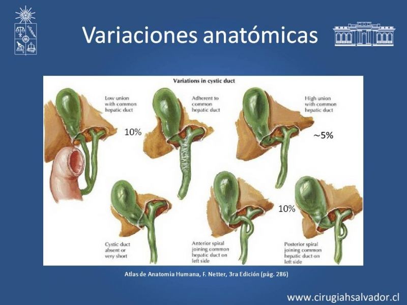 Diapositiva 19 de Colecsitectomía Segura