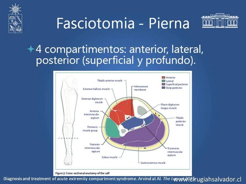 Diapositiva 18 de Síndrome Compartimental de Extremidades