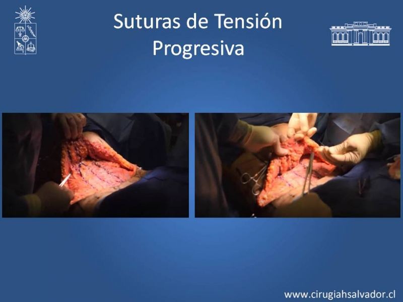 Diapositiva 22 de Lipectomía Abdominal