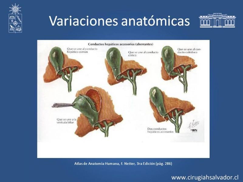 Diapositiva 18 de Colecsitectomía Segura