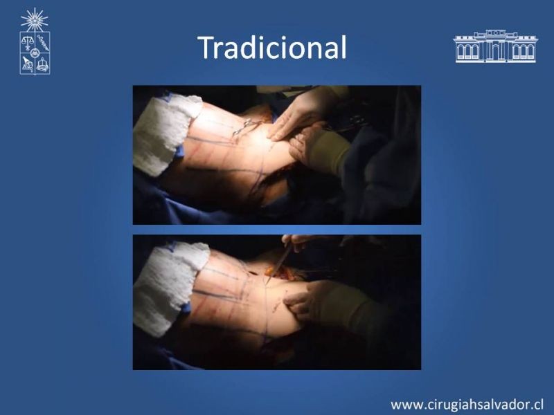 Diapositiva 16 de Lipectomía Abdominal