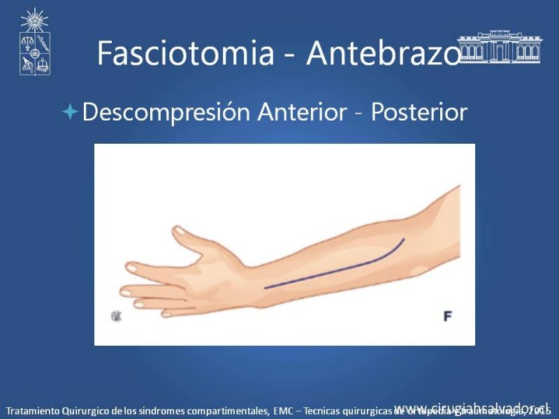 Diapositiva 30 de Síndrome Compartimental de Extremidades
