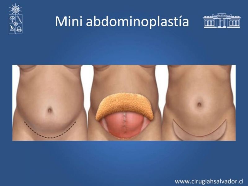 Diapositiva 12 de Lipectomía Abdominal
