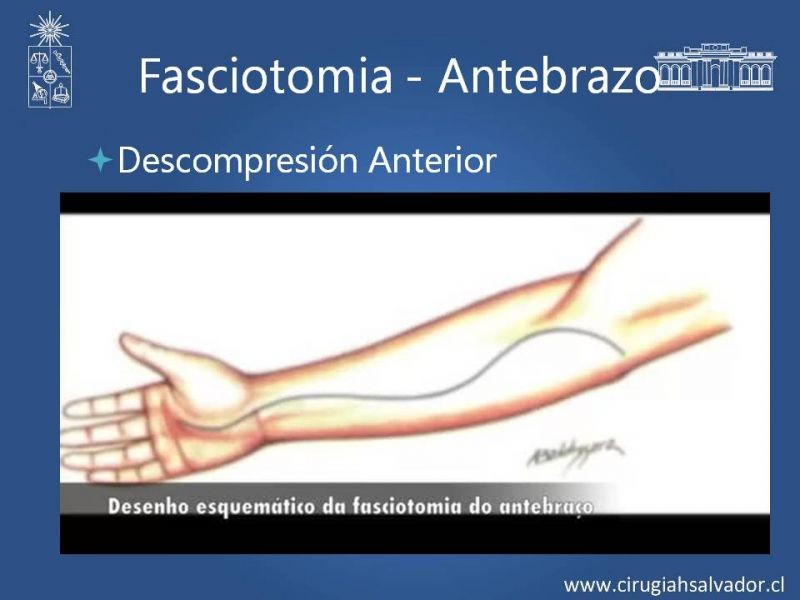 Diapositiva 29 de Síndrome Compartimental de Extremidades