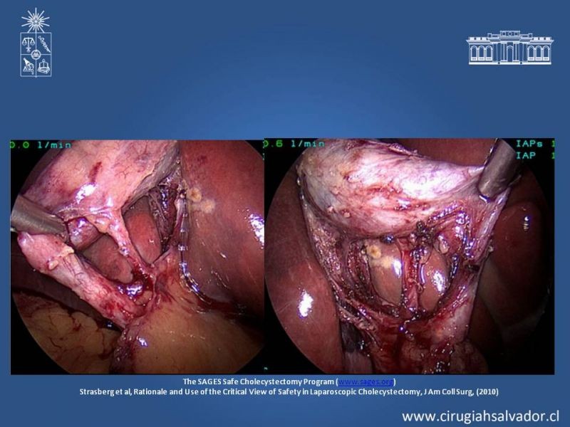 Diapositiva 13 de Colecsitectomía Segura