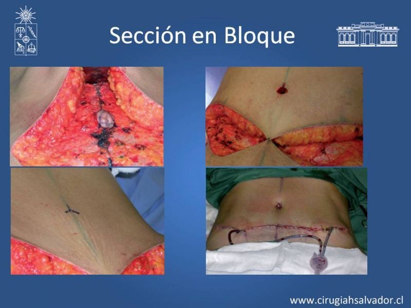 Diapositiva 20 de Lipectomía Abdominal
