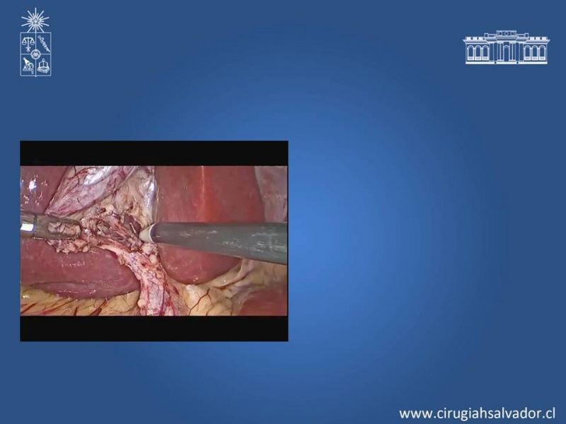 Diapositiva 14 de Colecsitectomía Segura