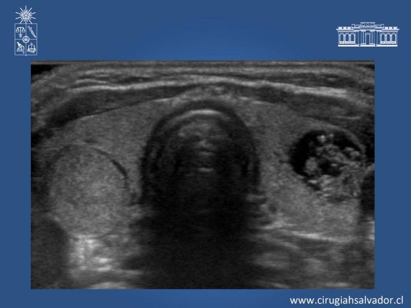 Diapositiva 17 de Nódulo Tiroideo