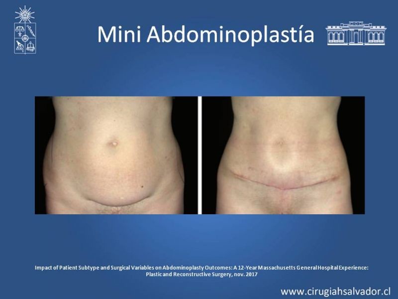 Diapositiva 13 de Lipectomía Abdominal