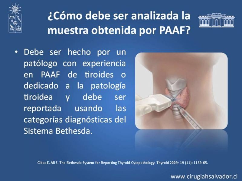 Diapositiva 25 de Nódulo Tiroideo